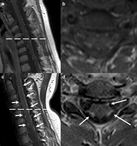 slice thickness brain metastatic